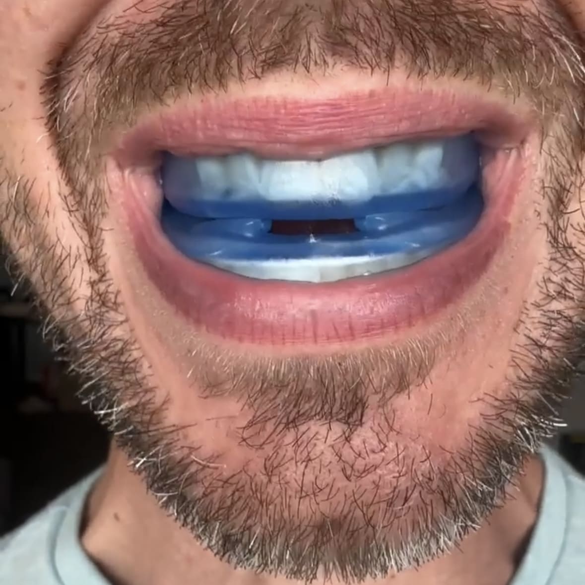 The Silent Sleep™ Anti-Snoring Mouthpiece Universal Size